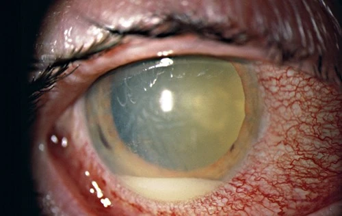 Aman dikkat! Kışla gelen G&ouml;z enfeksiyonlarına kesinlikle &ouml;nlem alın!