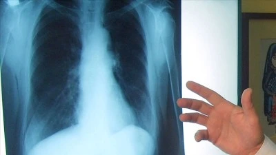 “Akciğer kanseri 50-70 yaş arasında daha sık görülüyor”