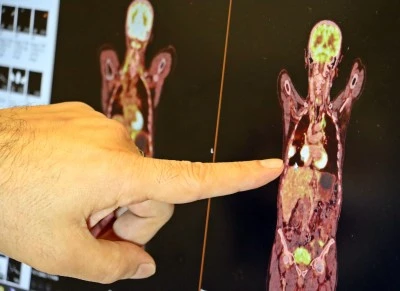 “Akciğer kanseri tedavisinde sağ kalım oranları artıyor”