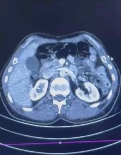Midelerinde uyuşturucu taşıyan 3 kurye yakalandı